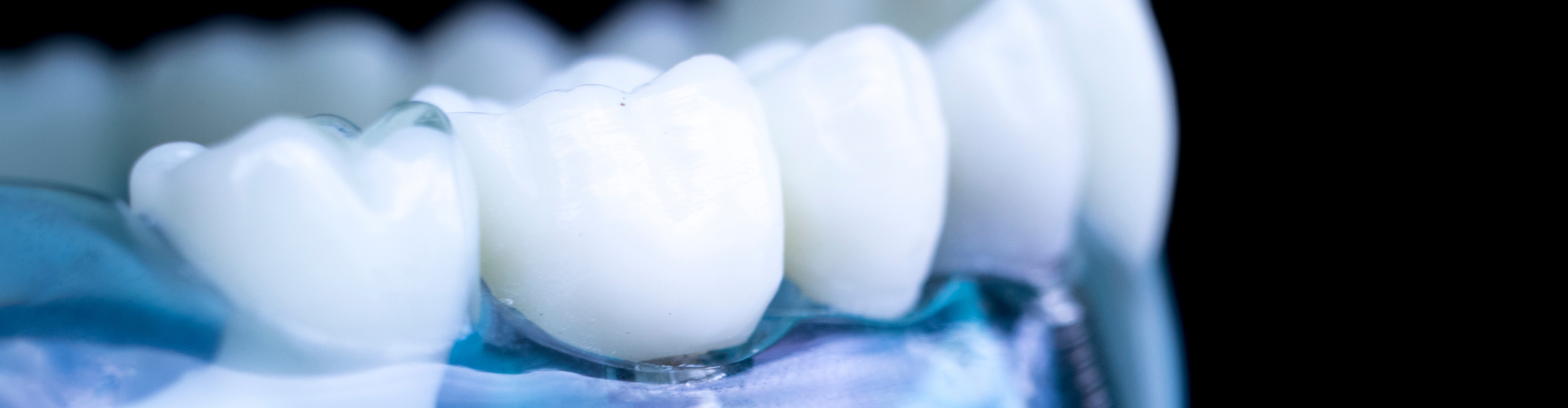 A transparent denture model demonstrating how a dental implant is placed.